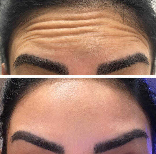 Frontalis