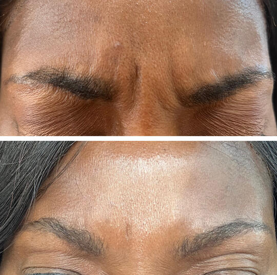 Glabella